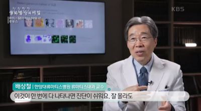 [KBS 생로병사의 비밀] 류마티스질환과 싸우는 청춘_루푸스편